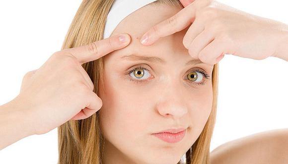 ¿Cómo prevenir el acné juvenil? Cinco consejos que te ayudarán