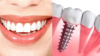 Implantes dentales: todo lo que tiene que saber sobre este tratamiento