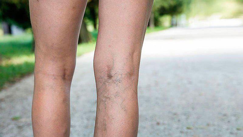 ​Ofrecen cirugías láser de várices por el Día de la mujer