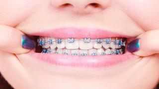 6 cosas importantes que debe saber antes de ponerse brackets