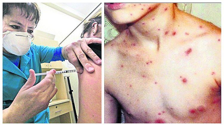 Aumento de la varicela en el Perú asusta a padres de familia