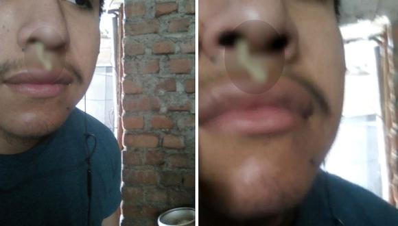 Estudiante denuncia que le dejaron gasa dentro de la nariz luego de operación en Hospital de Collique (VIDEO)