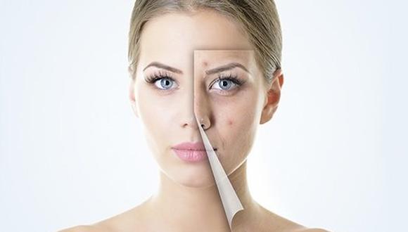 6 Tips para eliminar las molestas marcas de acné