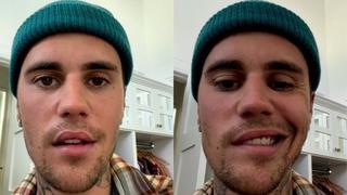 Justin Bieber alarma a sus fans tras compartir video con la mitad del rostro paralizado 