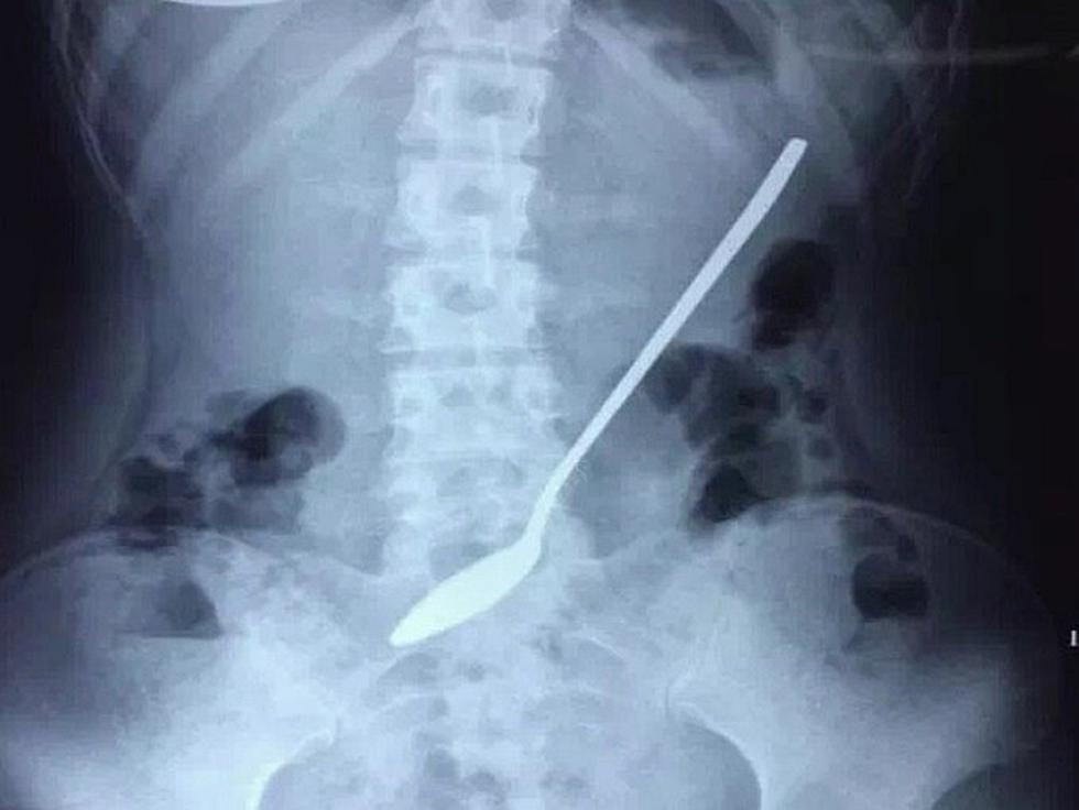 Estudiante universitaria decidió quedarse con cuchara en el estómago hasta terminar exámenes