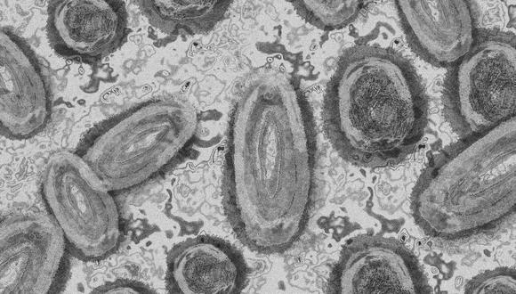 La varicela o la sífilis tienen síntomas similares a la viruela del mono. (Foto referencial: Pixabay)