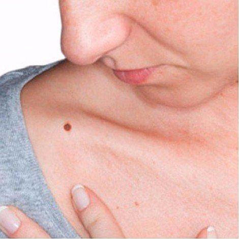  Conoce el significado de tu marca de nacimiento