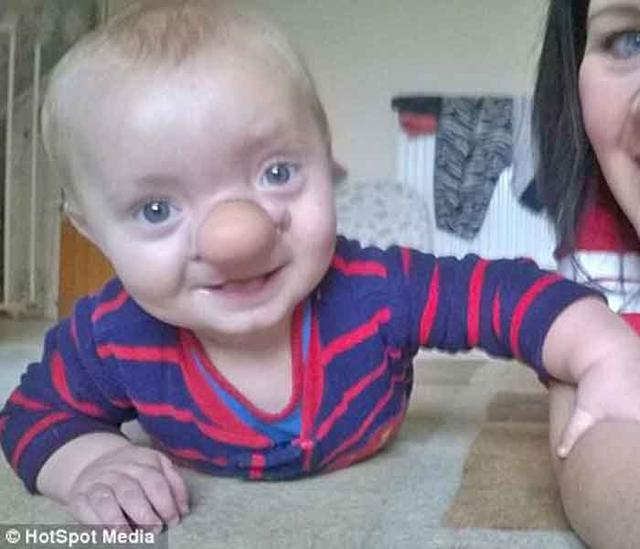 ​Esta es la conmovedora historia del "pinocho de la vida real" [FOTOS]