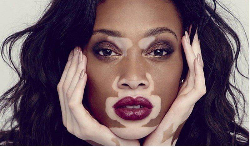7 mentiras sobre el vitiligo que debes olvidar