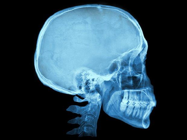 ​¿Se puede vivir sin cerebro? Conoce el alucinante caso del genio matematico que lo logró
