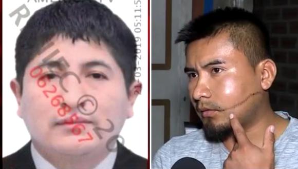 Hombre es desfigurado pero termina detenido porque su agresor lo denunció (VIDEO)