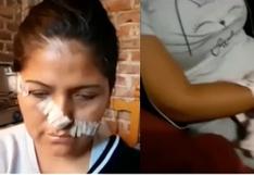 Barranca: mujer termina con la cara desfigurada tras agresión de sus vecinas