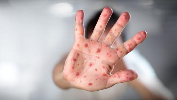 Los casos descartados hasta ahora en Lima se trataban de otras enfermedades eruptivas como la varicela, y enfermedad de mano, pie y boca. (Foto referencial GEC)