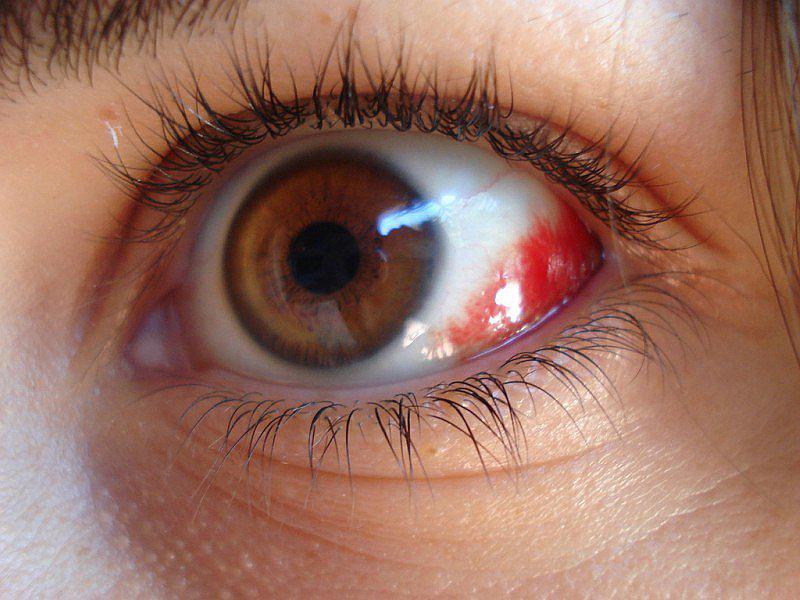 ¿Cómo debemos actuar ante un derrame de ojos?