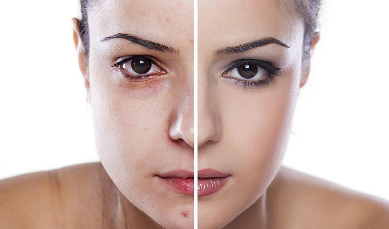 ¿Piel grasa? 5 remedios caseros para ganar la batalla