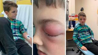 Niño de 9 años casi pierde la visión a causa del “ojo covid” en Reino Unido