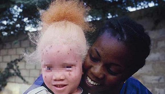 ​Secuestran y decapitan a niña albina de apenas 5 años