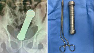 Hombre fue al médico en Brasil por dolor abdominal y al final le encontraron una mancuerna 