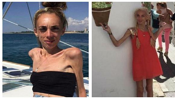 Mujer se recupera y luce distinta tras pesar tan solo 25 kilos (FOTOS)