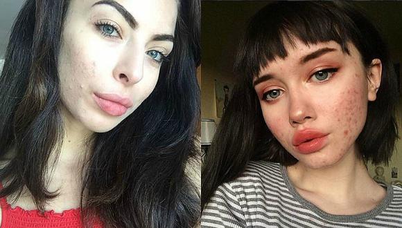 Instagram: acné en fotografías se ha vuelto tendencia de belleza