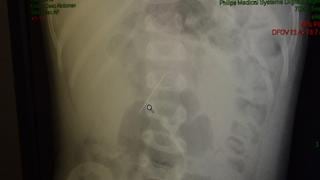INSN de Breña: médicos operan con éxito a niño de 2 años que tenía una aguja incrustada en el intestino