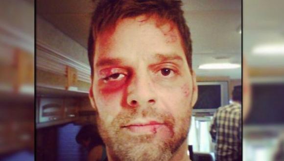 Ricky Martin publica foto con el rostro golpeado 