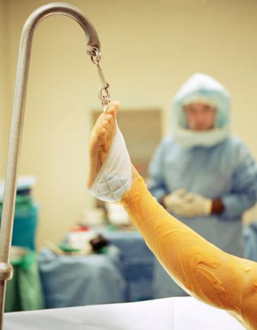 En España realizarán primer trasplante de piernas