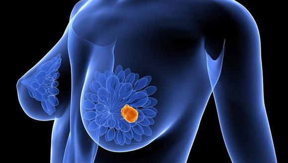 Identifican gen "esencial" que resiste cáncer de mama agresivo 