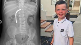 Niño de 9 años pierde apéndice e intestinos por seguir un reto viral con imanes en Tik Tok