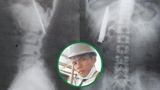 Hombre en Filipinas fue apuñalado y más de un año después descubre que todavía tenía el cuchillo en su pecho
