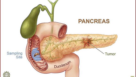 Hallan componente que puede dar marcha atrás al cáncer de páncreas 