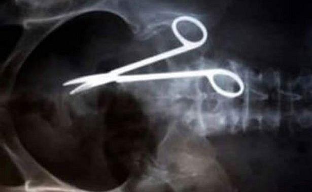 Retiran tijeras a hombre que las llevaba 18 años en el estómago  