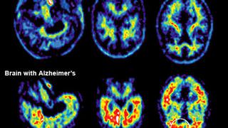 La resistencia del cerebro al estrés previene el alzheimer 