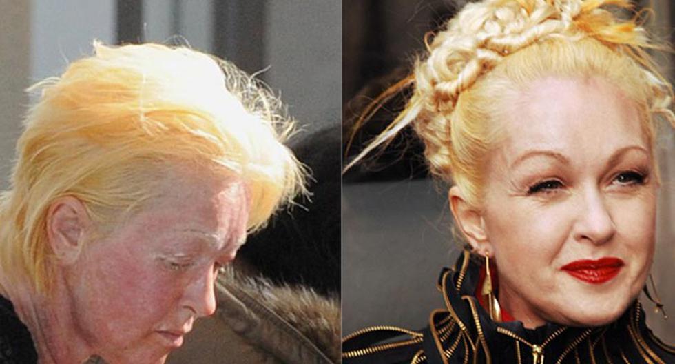 Cyndi Lauper revela un doloroso tratamiento anti edad ACTUALIDAD OJO