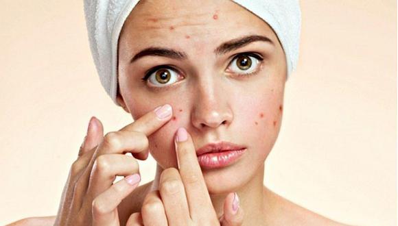 Los remedios caseros que no se deben usar para el tratamiento del acné