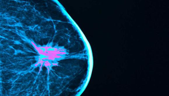 Evitan que células del cáncer de mama se escondan en los huesos 