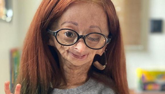 Adalia Rose Williams nació con progeria, también conocida como síndrome de Hutchinson-Gilford. (Foto: @adalia06).