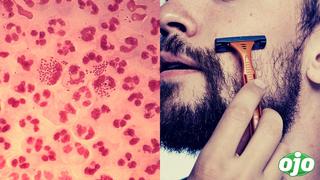 Joven se infecta con bacteria “come carne” tras afeitarse con rasuradora de su amigo
