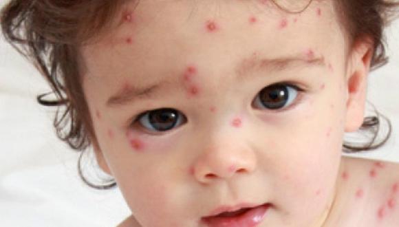 Cuidado: los niños son vulnerables a la varicela