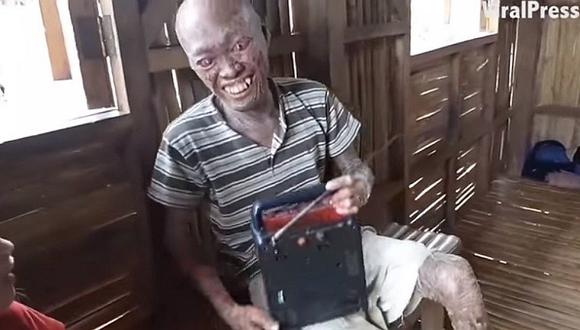 YouTube: le dicen "demonio" porque sufre extraña enfermedad en la piel (VIDEO)
