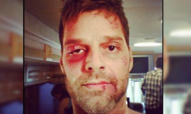 Ricky Martin publica foto con el rostro golpeado 
