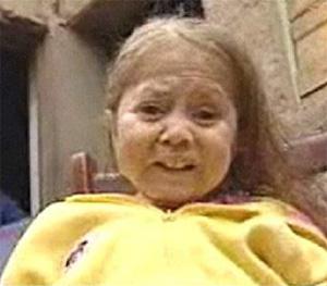 Niña peruana de 8 años parece anciana de 80 