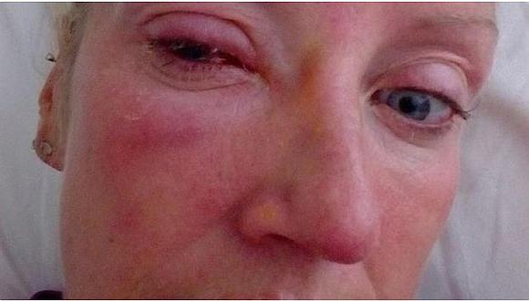 Mujer queda ciega por parásito que le "devoró" el ojo 
