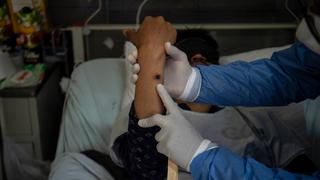 Viruela del mono en Perú: La Libertad y Arequipa serán las próximas regiones donde continuará el proceso de vacunación 