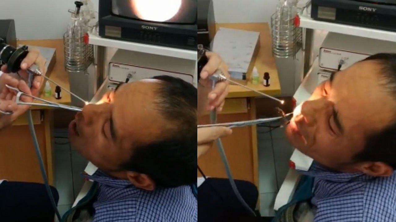 Hombre se quejaba por fuerte dolor en la nariz y le encuentran un curioso animal (VIDEO)