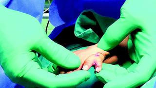 ​Hospital del Niño: operarán gratis a menores con deformaciones en las manos