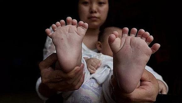 China: Nace niño con 31 dedos en manos y pies