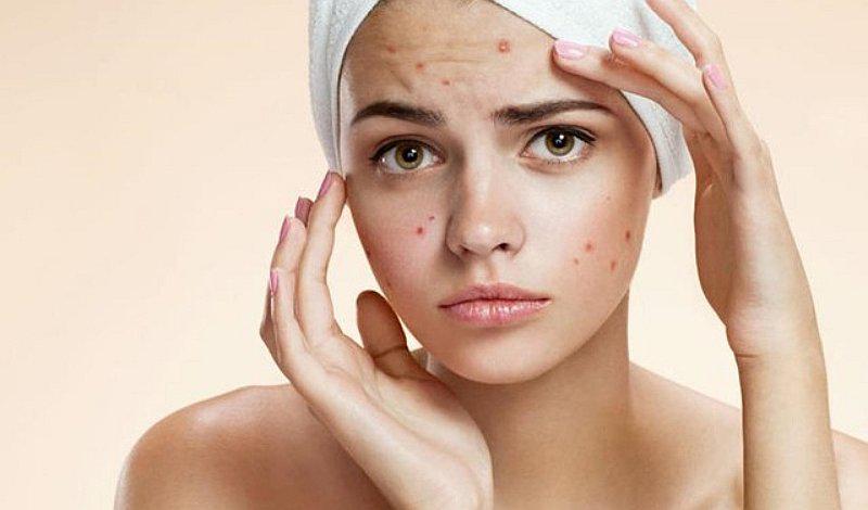 5 cosas que debes saber sobre el acné