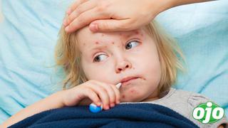 Enfermedades eruptivas en niños: ¿Cómo diferenciar la varicela, sarampión y rubéola?