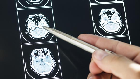 Closeup of brain MRI scan result